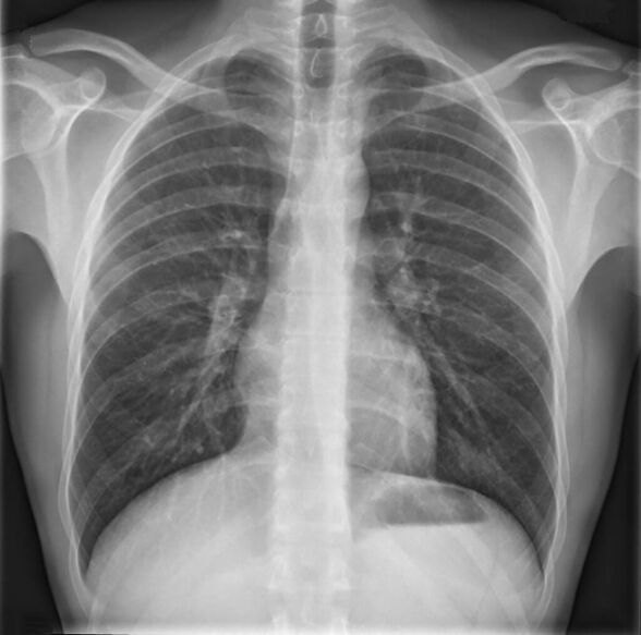 Krūšu mugurkaula osteohondroze tiek diagnosticēta, izmantojot rentgenogrāfiju