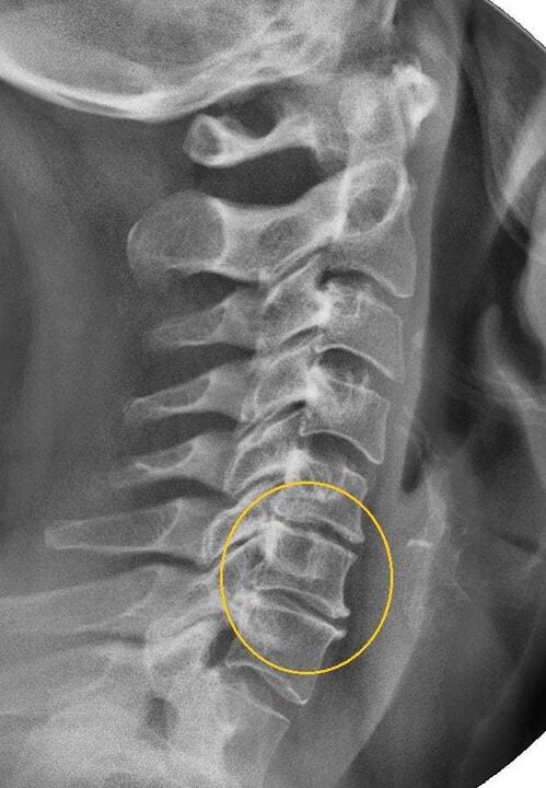 osteohondroze