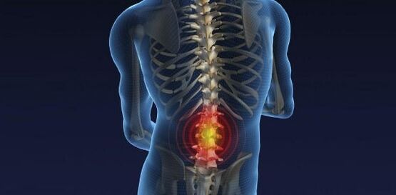 Muguras sāpes ar jostas osteohondrozi