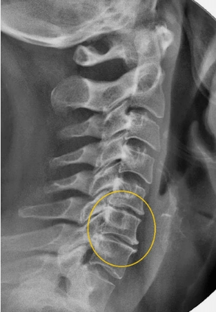 Dzemdes kakla mugurkaula osteohondroze uz x -ray