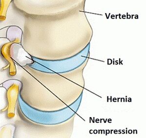 Dzemdes kakla reģiona osteohondroze