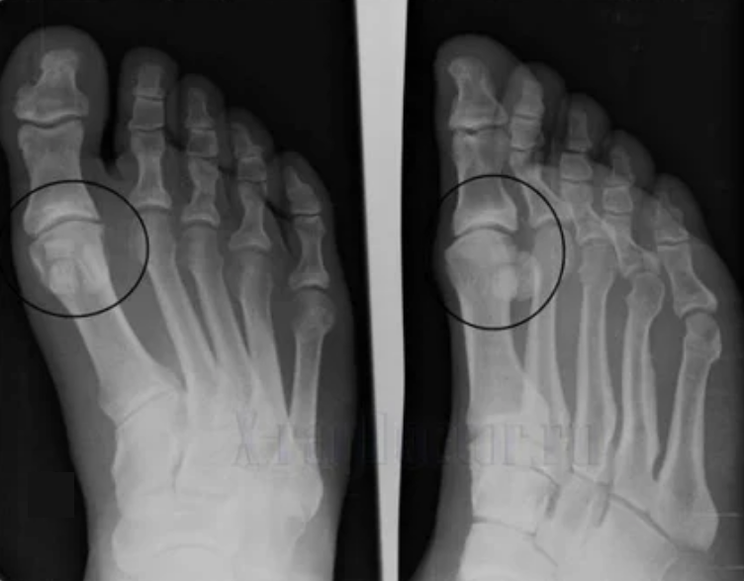 Artrozes diagnoze