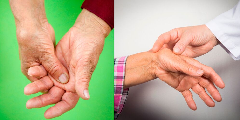 pietūkums un sāpošas sāpes ir pirmās roku artrīta pazīmes