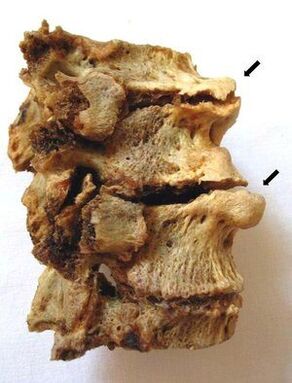 Osteohondrozes skartā skriemeļa daļa