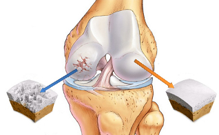 osteoartrīts ceļa locītavai