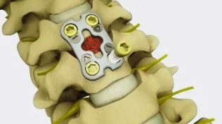 ķirurģiska ārstēšana osteohondrozes